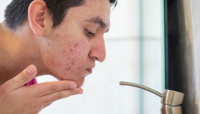 Red Light and Blue Light Therapy for Acne Treatment