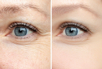Before and After for Eye Wrinkles