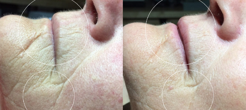 Before and after comparison of a person's nose with visible skin texture differences.
