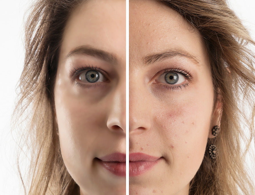 Woman before and after acne treatment with light therapy