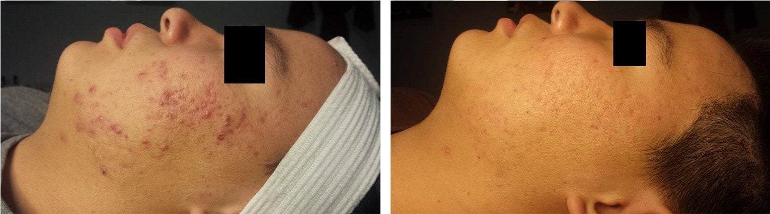 Acne Treatment Before/After