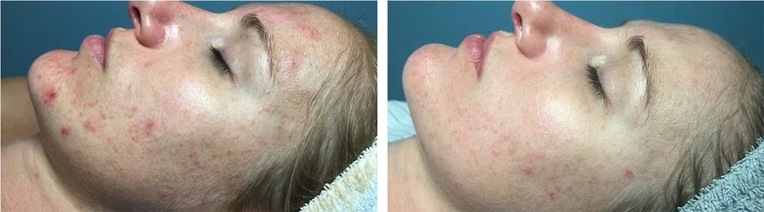 Acne Treatment Before/After