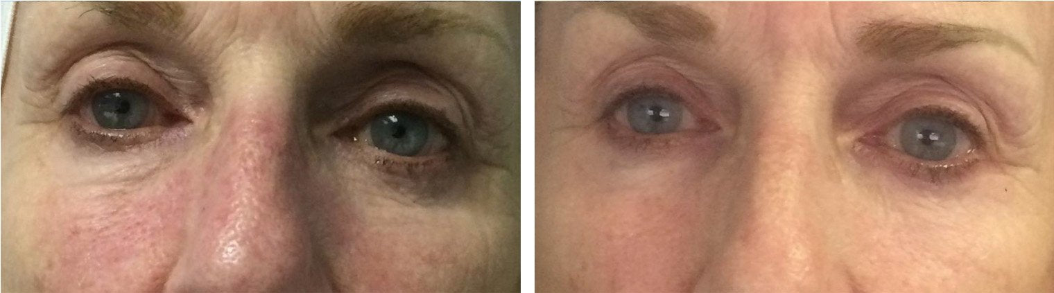 Anti-Aging Eyelid Rejuvination Before/After
